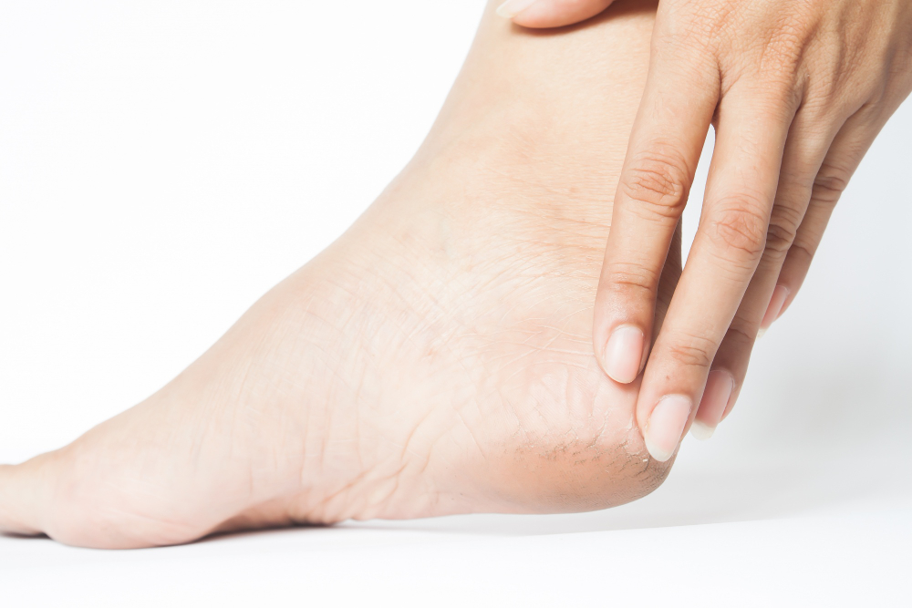 Woman Cracked Heels With White Background Foot Healthy Concept