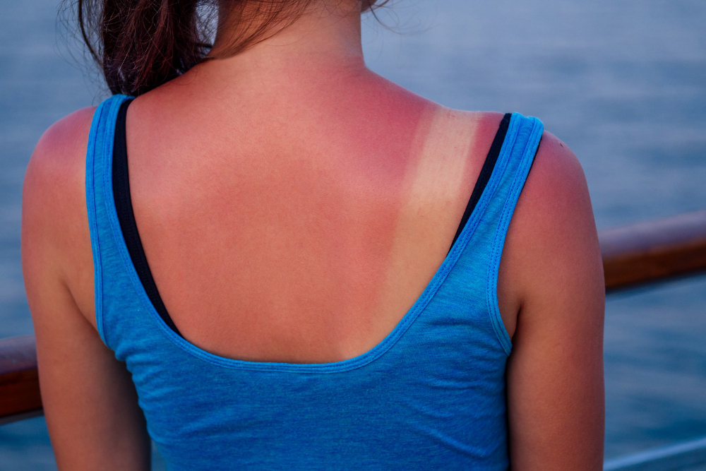 Burnt Female Skin Sun Close Up Blue T Shirt