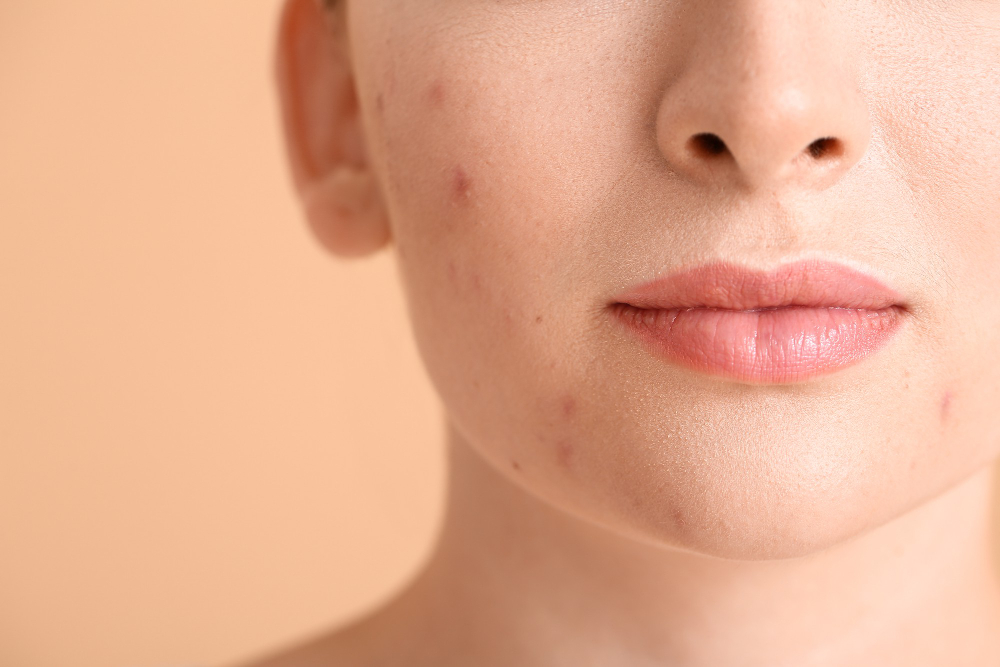 Young Woman With Acne Problem Color