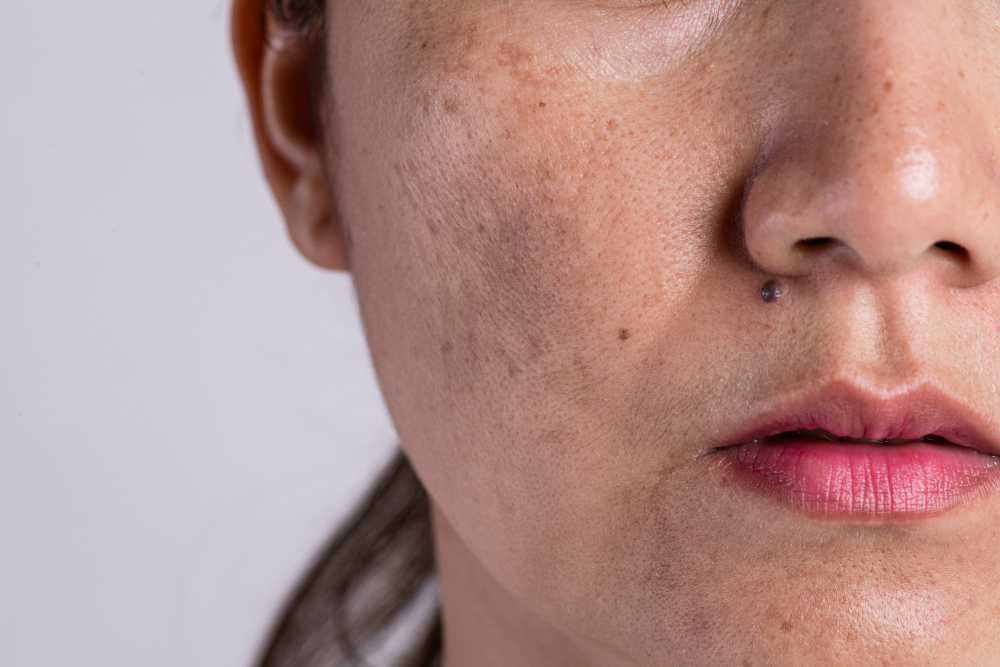 Woman With Problematic Skin Acne Scars Problem Skincare Concept