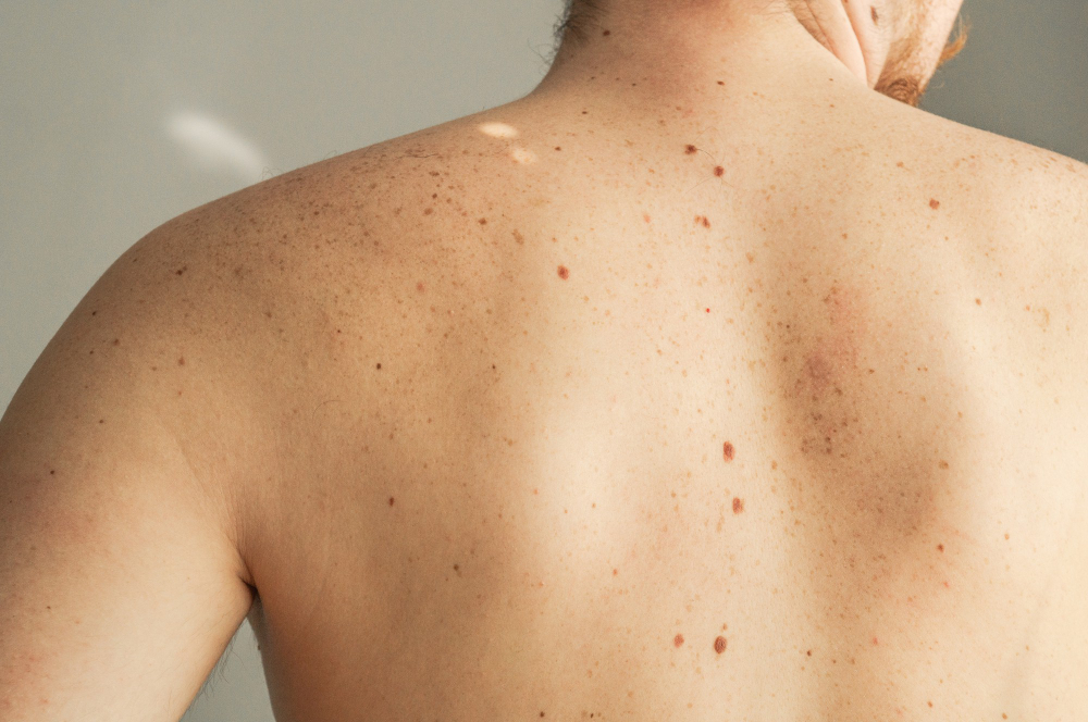 Close Up Detail Bare Skin Man Back With Scattered Moles Freckles Checking Benign Moles